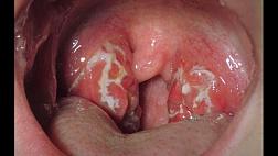 Модифицированная шкала оценки Центора (Centor score) и МакАйзека (McIsaac score) Шкалы по оториноларингологии. Острый тонзиллофарингит